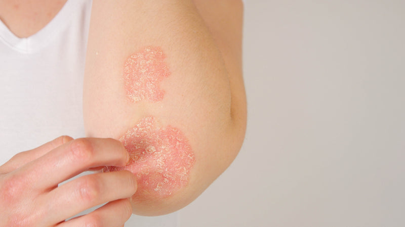The pH of skin